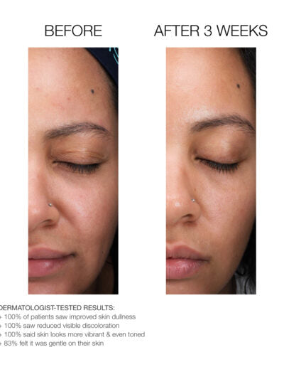 Travel Size Lactic Acid Retexturing Micro-Peel