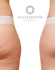 Fat and Cellulite Reduction Cream