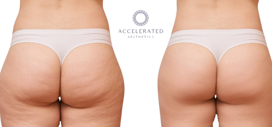 Fat and Cellulite Reduction Cream